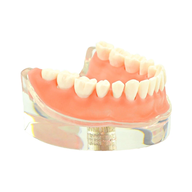 Възстановяване на зъбни импланти Модел на зъбите Сменяем мост Модел на обучение по стоматология Стоматологичен инструмент